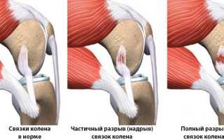 Симптомы растяжения связок коленного сустава