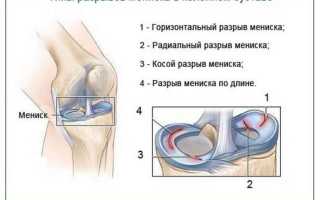 Растяжение мениска